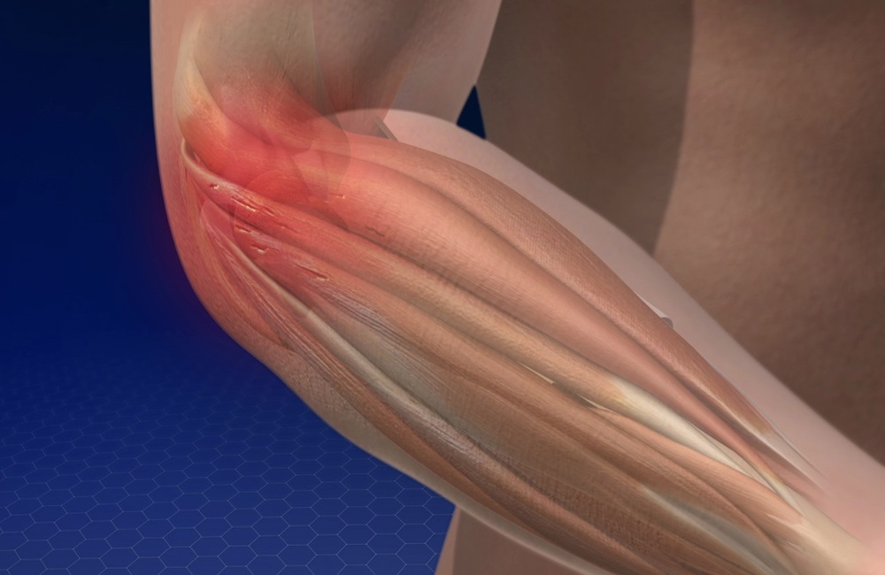Lateral Epikondilit (Tenisçi Dirseği)